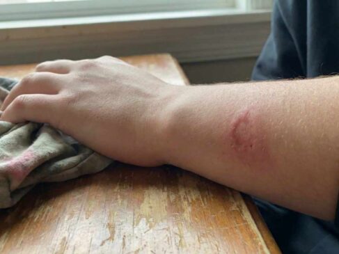 تفسير حلم العض من شخص غير معروف